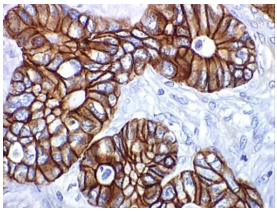 Figure 2: The IHC staining showing membrane and cytoplasmic positivity for a particular biomarker in colon cancer cells.