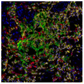 Figure 3: Detection of human CD3 (yellow), CD20 (green), and CD68 (red) in FFPE lung carcinoma by IHC-IF.